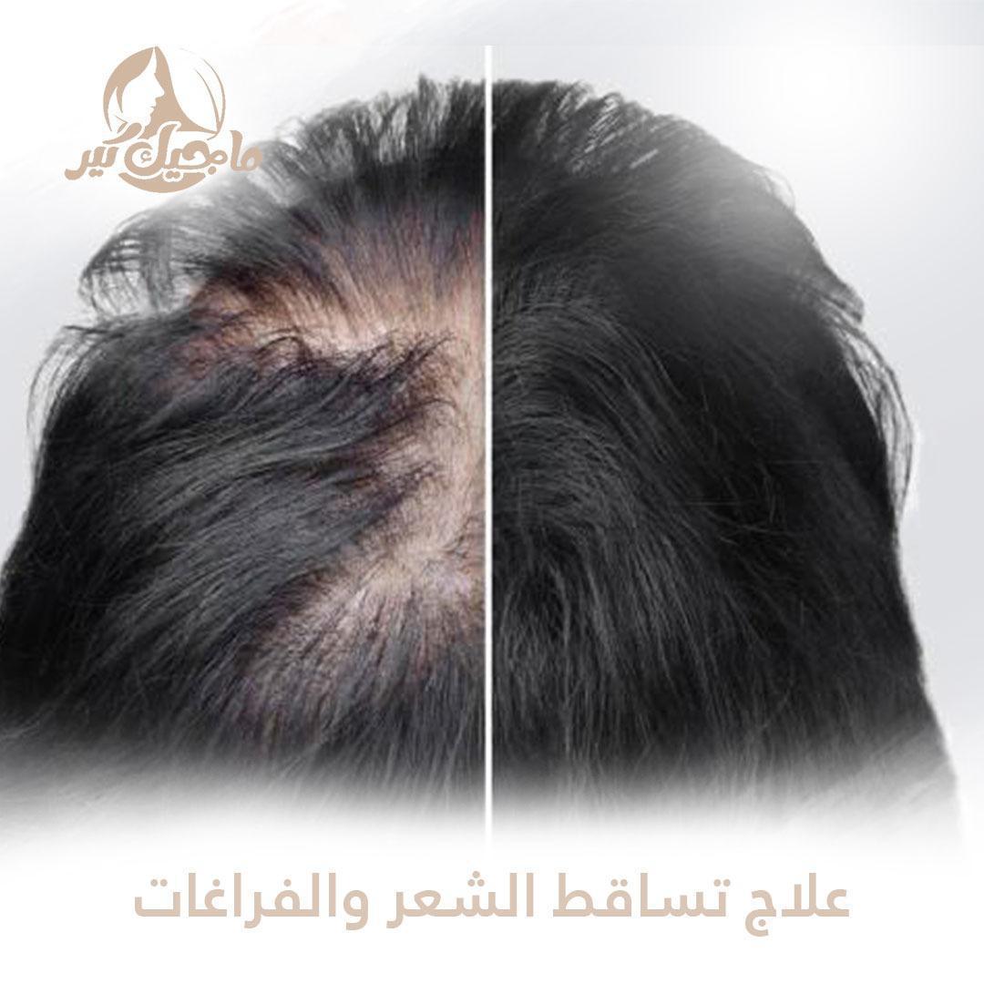 جلسة عالج تساقط الشعر والفراغات